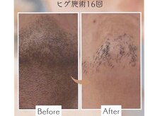 アカヌケ(AKANUKE)/ヒゲ脱毛