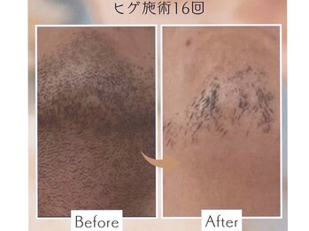 アカヌケ(AKANUKE)/ヒゲ脱毛