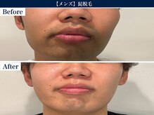 【フォトRFメンズヒゲ脱毛】　ビフォーアフター