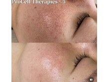 ルチル(Rutile)/プロセルセラピーズ