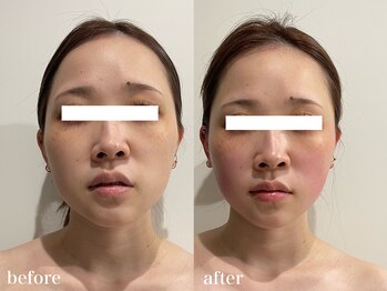 クリア(CLEAR)/小顔美整顔