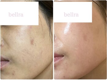 ベルラ(BELLRA)の写真/美肌/小顔/毛穴ケアを1回で完了★陶肌ハーブピーリング+サーマルフラクショナルRF打ち放題+ハイドラ洗浄★