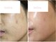 ベルラ(BELLRA)の写真/美肌/小顔/毛穴ケアを1回で完了★陶肌ハーブピーリング+サーマルフラクショナルRF打ち放題+ハイドラ洗浄★