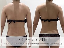 ミヨンラボ(miyon LABO)/ハイパーナイフ 1回