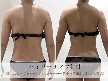 ミヨンラボ(miyon LABO)/ハイパーナイフ 1回