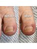テープタイプの巻き爪矯正！1本＋爪ケア付き（フットケア）