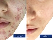 顎ニキビも改善！赤み/跡も残さずキレイな肌に