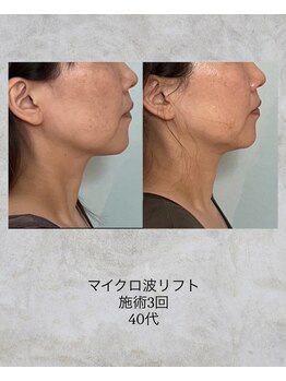 コンクパール(CONCH PEARL.)/マイクロ波リフト