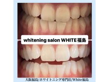 ホワイトニングサロン ホワイト(WHITE)/セルフホワイトニング/大阪/福島