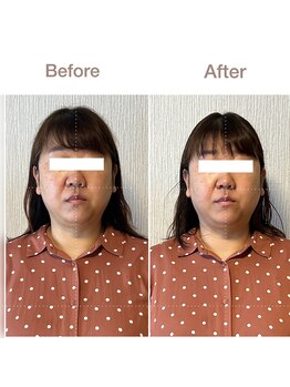 紡(TSUMUGU)/骨格補正スパ＋顎矯正(1回目)