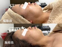 キーオブフェイス(Key of Face)/お悩み【乾燥+たるみ】