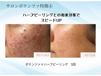 エイミー(Aimee)/ハーブピーリングとの相乗効果