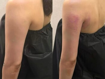 ミロク(369)の写真/二の腕やブラはみ肉などのパーツを脂肪冷却or強力脂肪分解成分導入でケア！目指せ！理想のライン♪