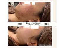 フロージア 新宿南口店(FLOGIEIA)の雰囲気（ハーブピーリングと肌管理韓国マシンを肌状況によって使い分け）