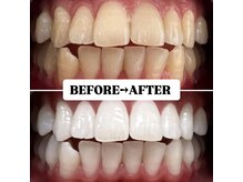 ホワイトニングサロン 豊中/Before&After美白ホワイトニング