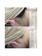 TD 清洲店/うなじ脱毛