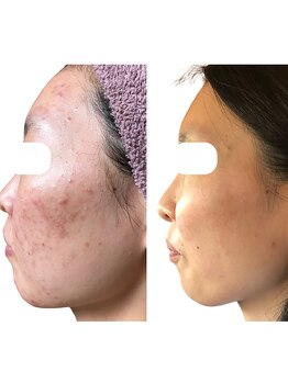 エステティックサロン ドゥネール/【1年間、月に2回】ニキビケアー