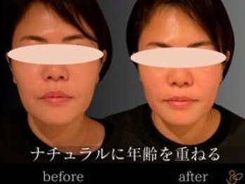 チョコバリ 渋谷店(chocobari)/小顔×リフトアップ(美容鍼)20代