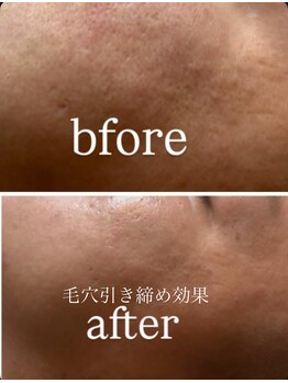 プレシャス(Precious)/ハーブピーリングで毛穴引き締め