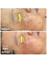 タイカ(Taika)/浸透攻撃！長年のシミケア悩みに