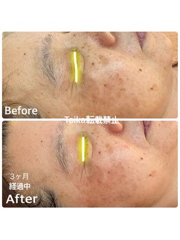 タイカ(Taika)/浸透攻撃！長年のシミケア悩みに