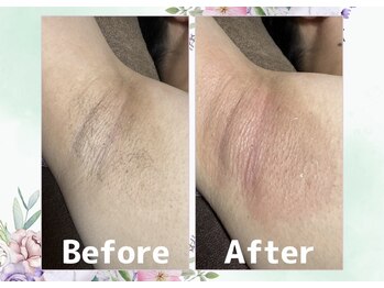 プルート(Pluto)/脇脱毛 Before/After