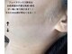 ピークハント(Peak Hunt)の写真/《フェイスワックスメニューあります! 》どの角度から見られてもツルンと美肌◇至近距離でも自信が持てる！