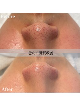 アール アンド ビューティーサロン(Ｒ＆ BeautySalon)/毛穴撃退！！