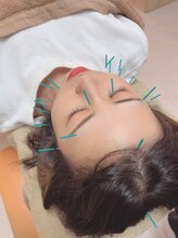 ヒーリングサロン アージュ(A-je)/★美顔鍼＋小顔矯正★