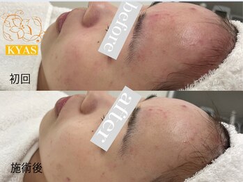 キャス(KYAS)/[ハーブピーリング]ニキビケア◎