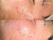 レイル(REIR)/メニュー：純粋レチノールピール