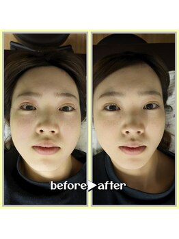 リボーン(Reboorn)/小顔になりたい/すっきりしたい