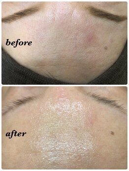 ナオ鍼灸院(Nao鍼灸院)/美容鍼と炭酸パックの施術