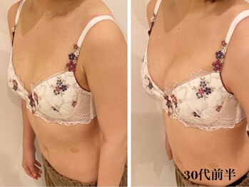 リール 新宿店(RIRE)/30代前半 バストアップ症例