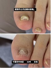 巻き爪じゅん 千葉駅前店/肥厚爪とでお悩みでご来院