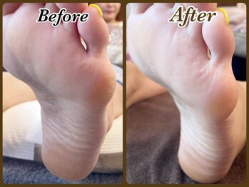 ビューティースパ(Beauty-Spa)/【硬く厚い足裏の角質除去】