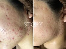 ストーリー 沼津店(STORY)/ハーブピーリング専門店STORY