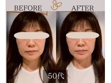 チョコバリ 新宿店(chocobari)/小顔×リフトアップ(美容鍼)20代