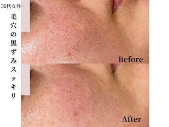 ヴィタベラ(Vita Bella)/VERUNAハーブピーリリング