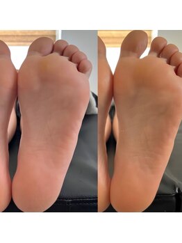 角質ケアができるサロン