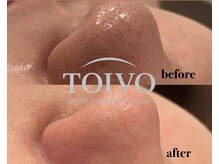 トイヴォ(TOIVO)/毛穴洗浄ビフォーアフター！