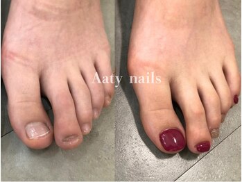 【深爪矯正】フット