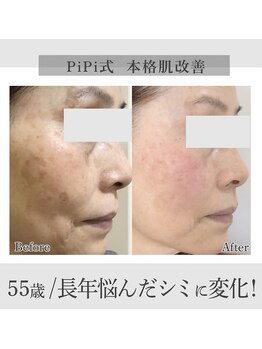 グランピピ(Grand PiPi)の写真/シミ・たるみ、色々試しても変わらなかった40代・50代・60代の方へ