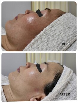 レゾン 京橋店/【Before/after】レチノールTR