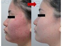 ブリリアン デイスパ 阪急西宮ガーデンズ店(BRILLIAN DAYSPA)/水光ピーリング