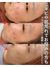 大人気♪ニキビケア・ハリツヤ弾力★プラズマシャワー＋ビタミン美容液3500円