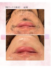 ソワイユ 浜松店(Soyeux)/髭ワックス脱毛　 before→after