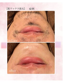 ソワイユ 浜松店(Soyeux)/髭ワックス脱毛 before→after