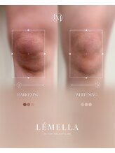 ソレラ(sorelle)/ルメラ色素ケア