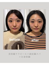 マホロバ(mahoroba)/美容鍼＋ララピール